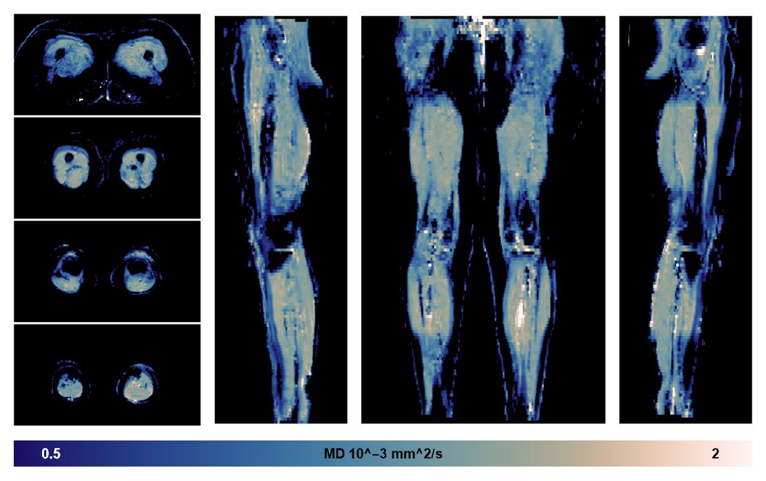 IVIM corrected whole leg muscle mean diffusivity obtained from diffusion tensor imaging.